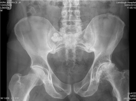 Hip Replacement Urgently Needed